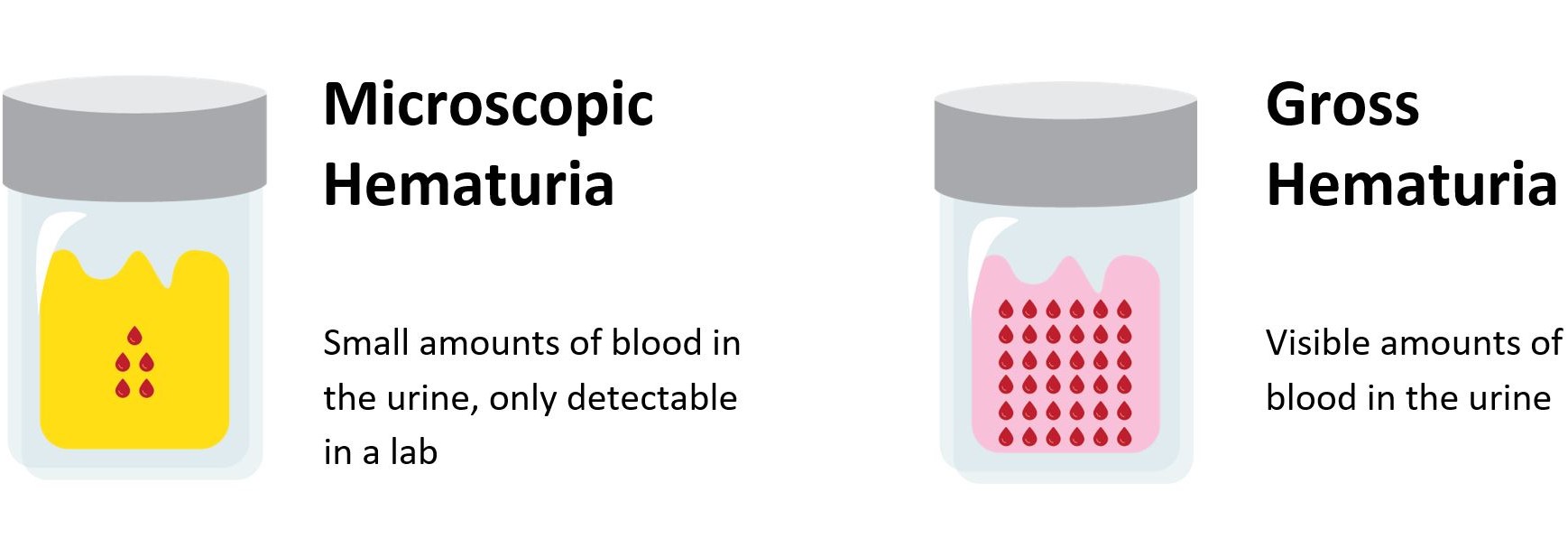 Graphical representation of microhematoria vs. macrohematoria